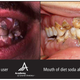 Illustration for article titled Your Diet Coke Habit Is Ruining Your Teeth as Badly as Meth or Crack